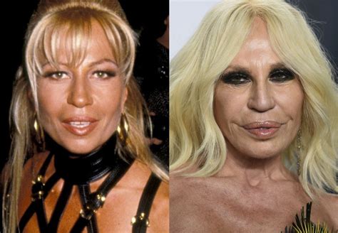 versace plastica facciale|donatella versace botox.